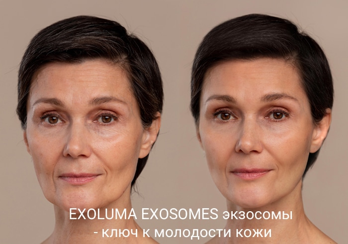экзосомы до и после